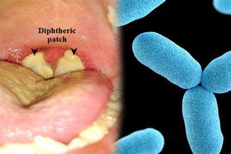 Diphtheria Outbreak in Nigeria: अफ्रीकी देश नाइजीरिया में डिप्थीरिया का प्रकोप, 200 से ज्यादा ...