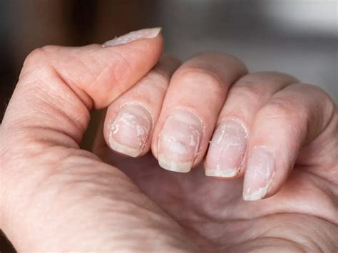 Do not ignore iron deficiency, such signs start appearing on nails and ...