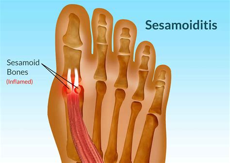 Sesamoiditis causes, symptoms, diagnosis & treatment