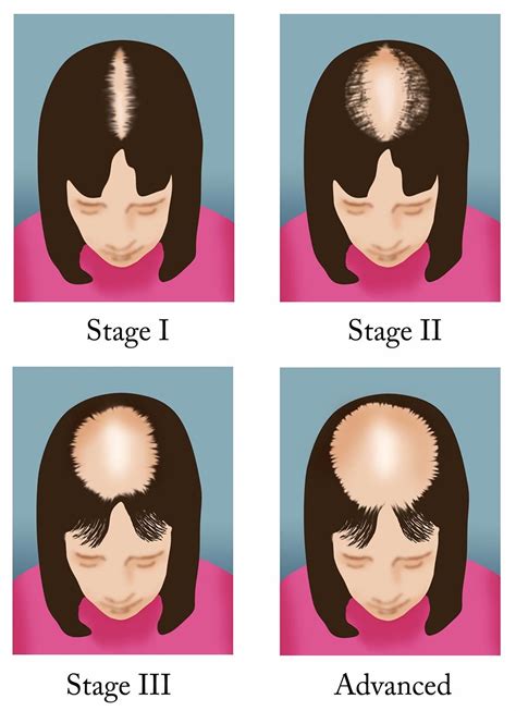 Medical for Us: Hair Loss : Types, Cause, Prevention, Treatment