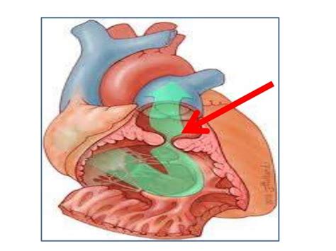 Case presentation ,double chambered right ventricle