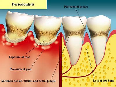 Tay Dental Surgery | Gum Disease