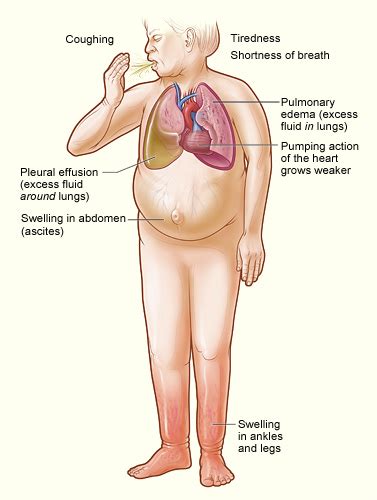 Heart Failure - Symptoms | NHLBI, NIH