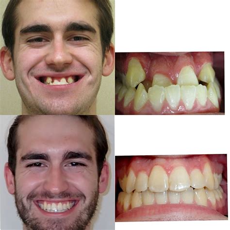 Orthodontist Braces Before And After