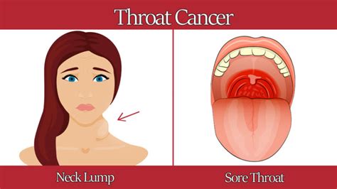 6 Warning Signs of Throat Cancer - WomenWorking