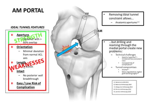 Comparison: Transtibial vs AM Portal vs Hybrid Technique | DanaMed