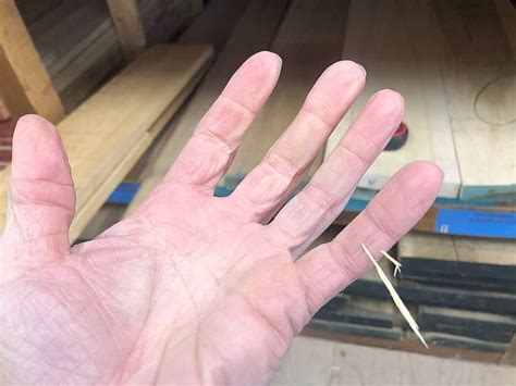 Workshop injuries | Canadian Woodworking