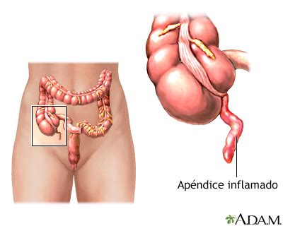 APENDICITIS - Mind Map