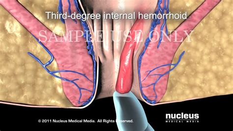 Hemorrhoid Classification System / Types of Hemorrhoid Surgery - YouTube