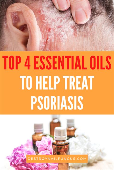 The Best Psoriasis Remedies – Essential Oils For Fast Relief