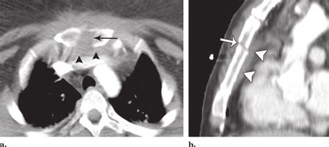 Sternal fractures. (a) Axial CT scan (soft-tissue window) shows a ...