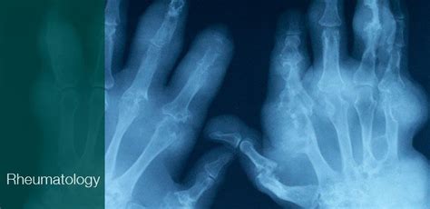 Rheumatoid arthritis x-ray | Fibromyalgia pain