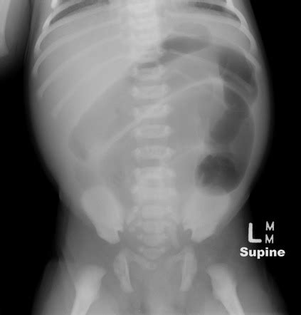 Hirschsprung disease | Radiology Reference Article | Radiopaedia.org