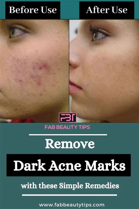 Completely Remove Dark Acne Marks with these Simple Remedies