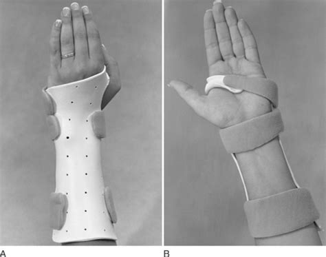 Volar Wrist Splint For Carpal Tunnel Syndrome - Captions Entry