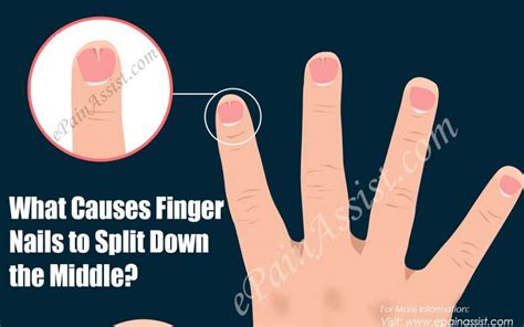 My Fingernail Keep Splitting? Here's What To Do - Get Long Nails