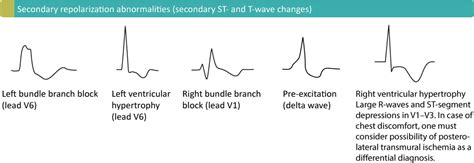 T-waves in ischemia: hyperacute, inversions (negative), Wellens sign ...