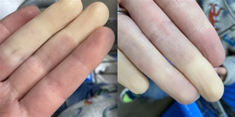 Raynaud's Disease Causes White Or Blue Fingers, Toes In Cold