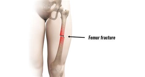 Femur Fracture (Acute) - Broken Thigh Bone Causes and Treatment