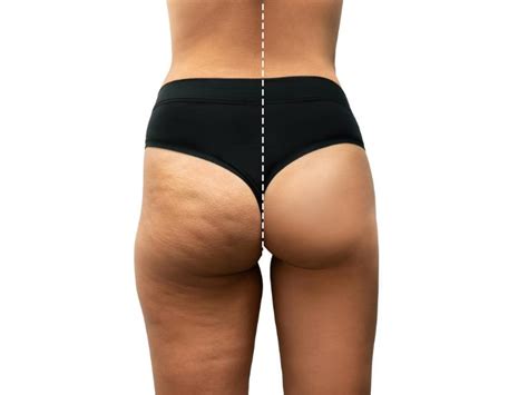 Brazilian Butt Lift Risks and BBL Complications In Iran