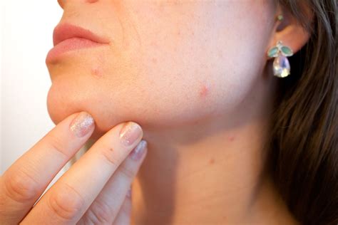 Adult Acne Causes: Why Is The Skin Disorder On The Rise?