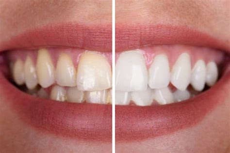 Whiten Your Teeth Naturally At Home | Absolute Dental