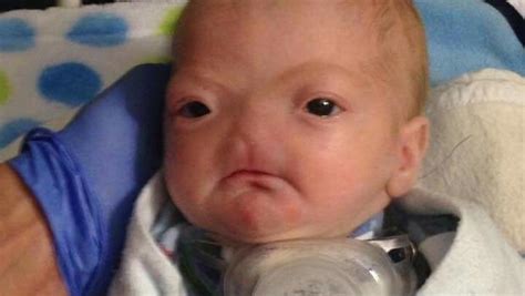 Mom seeks help for baby born without a nose - CBS News