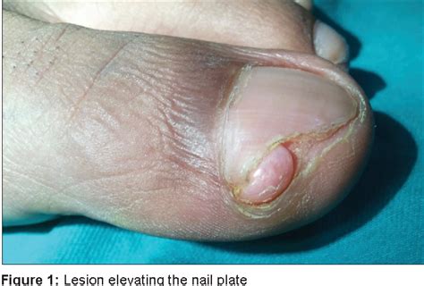 Figure 1 from Exostosis masquerading as a subungual wart | Semantic Scholar