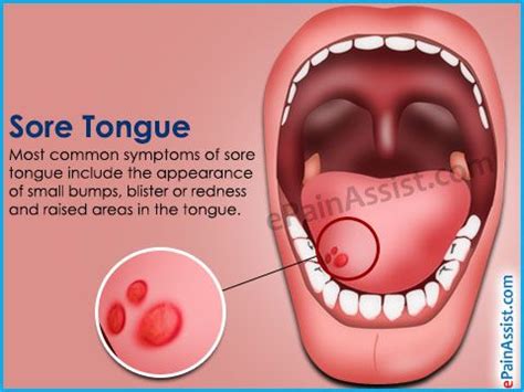 This article explains some of the best natural home remedies for sore tongue along with the most ...