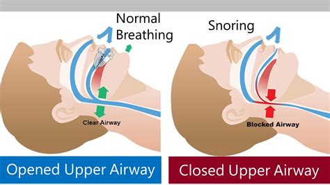 Stop Snoring with Dr. Bentsen Nasal Spray - Naturlig