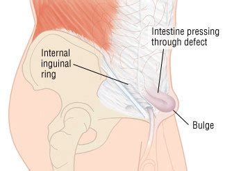 Inguinal Hernia Guide: Causes, Symptoms and Treatment Options