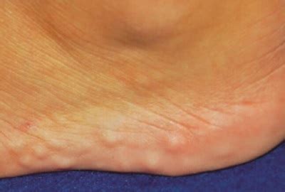 Lump On Side Of Foot: Common Causes & Treatment Options