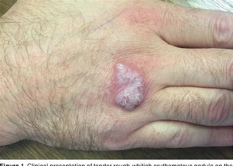 Figure 1 from Fish Tank Granuloma – a Case Report | Semantic Scholar