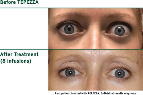 Chronic Thyroid Eye Disease Before & After TEPEZZA (teprotumumab-trbw)