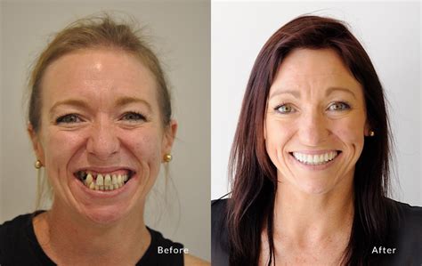 All-On-4®: Before And After | The Point Dental