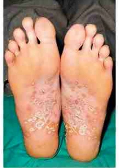 Keratoderma Blennorrhagicum