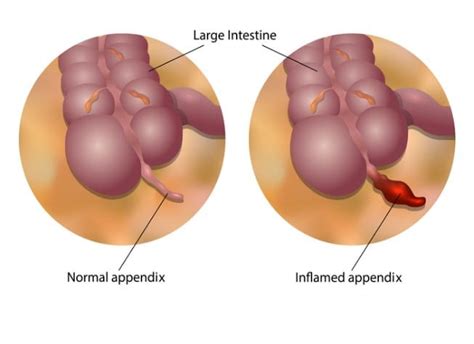 Perforated Appendix