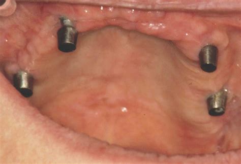 Dental subperiosteal implant – THE IMPLANT REGISTER