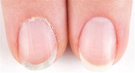 Overgrown Cuticles: Causes, Treatment, and Prevention - lazarusfround ...