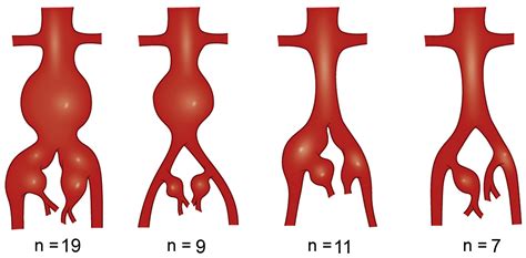 Endovascular treatment of hypogastric artery aneurysms - Journal of Vascular Surgery