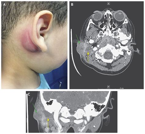 First Branchial Cleft Cyst | NEJM