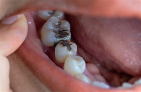 Silver Amalgam Filling Removal and Replacement - Steven C. Greenman, DDS