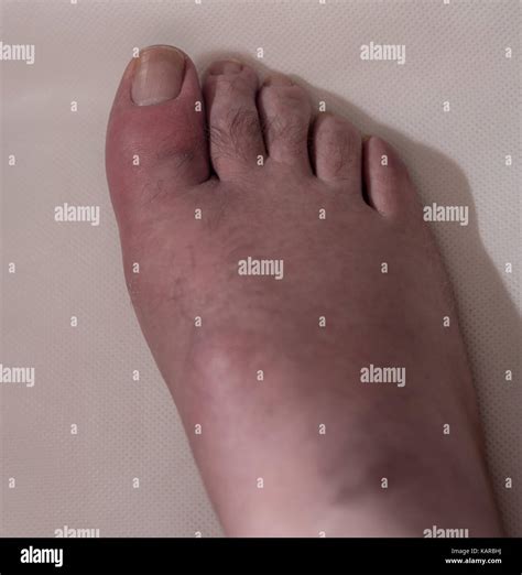 Big toe with gout, typical swelling, inflamation and skin peeling Stock Photo - Alamy