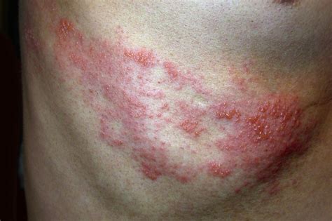 Identifying Skin Rashes Shingles