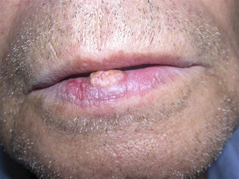 Squamous Cell Lip Cancer Pictures | Sitelip.org