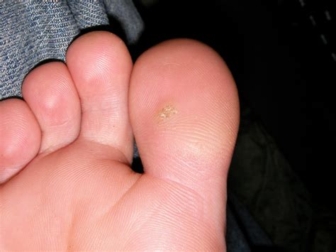 Plantar Warts Toe