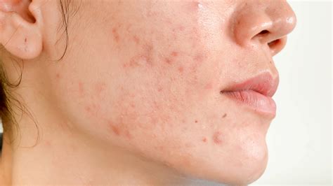 Acne Scars-Causes, Types, Treatments and Prevention Tips - Dr. Praneeth