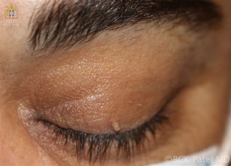 Eyelid Skin Tags: Causes And Treatment All About Vision, 46% OFF
