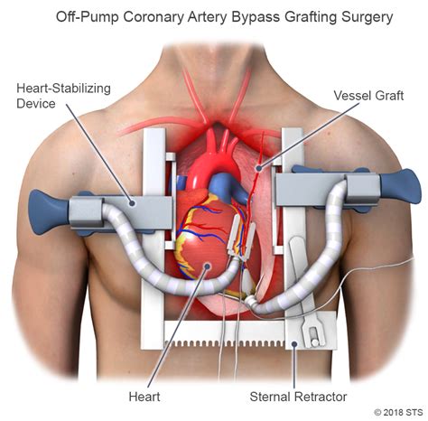 Coronary Artery Bypass Grafting (CABG) | The Patient Guide to Heart ...