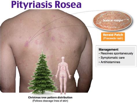 7 best Pityriasis rosea images on Pinterest | Natural treatments ...